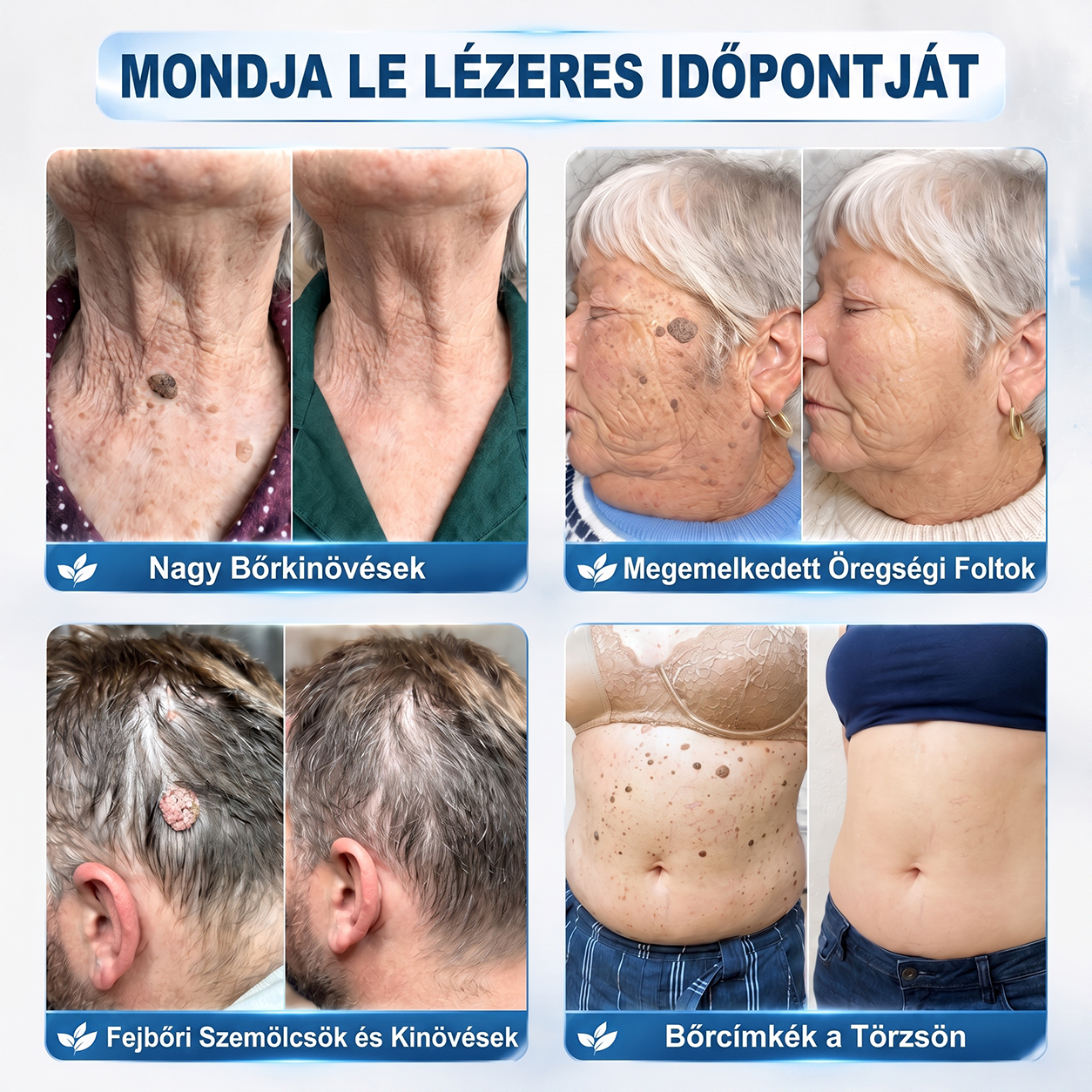 𝐇𝐈𝐒𝐊𝐈𝐍® 7 napos megoldás bőrkinövésekre és foltokra | Fájdalommentes precíziós rollerball, hegek nélkül