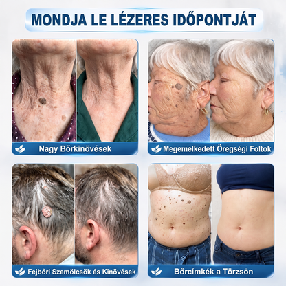 𝐇𝐈𝐒𝐊𝐈𝐍® 7 napos megoldás bőrkinövésekre és foltokra | Fájdalommentes precíziós rollerball, hegek nélkül