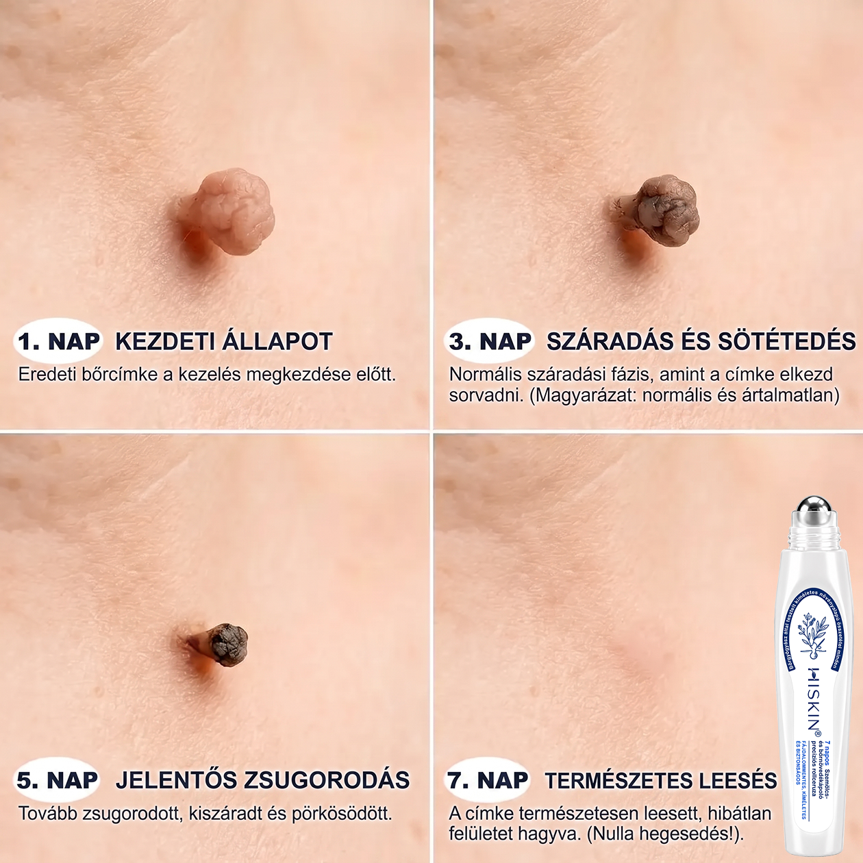𝐇𝐈𝐒𝐊𝐈𝐍® 7 napos megoldás bőrkinövésekre és foltokra | Fájdalommentes precíziós rollerball, hegek nélkül