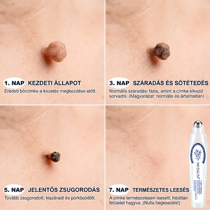 𝐇𝐈𝐒𝐊𝐈𝐍® 7 napos megoldás bőrkinövésekre és foltokra | Fájdalommentes precíziós rollerball, hegek nélkül